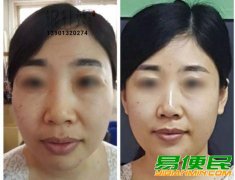 中医美容银针秀针灸美雕2021年招生培训