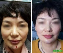 中医美容银针秀针灸美雕2021年招生培训