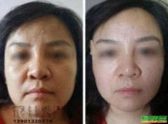 中医美容银针秀针灸美雕2021年招生培训