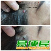 中医美容祛痣祛疣无痕无色沉技术培训