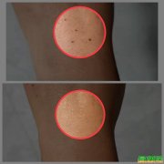 中医美容祛痣祛疣无痕无色沉技术培训