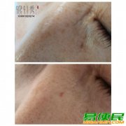 中医美容祛痣祛疣无痕无色沉技术培训